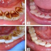孕妇能洗牙吗有牙结石,孕期可以洗牙吗有影响吗