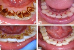 孕妇能洗牙吗有牙结石,孕期可以洗牙吗有影响吗