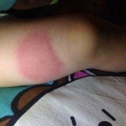 一岁多的宝宝腿上起一个大硬块怎么回事,胎儿肿块怎么确诊