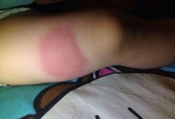 一岁多的宝宝腿上起一个大硬块怎么回事,胎儿肿块怎么确诊