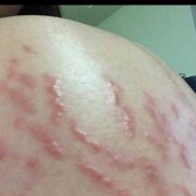 孕期肚皮发痒（孕期肚皮发痒是怎么回事）