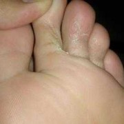 怀孕期间烂脚丫怎么办（怀孕期间烂脚丫怎么办啊）