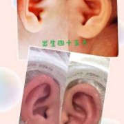 胎儿耳廓（胎儿耳廓形态异常难道就是畸形吗）