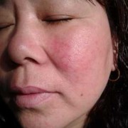 孕妇得皮炎影响胎儿吗（孕妇得皮炎影响胎儿吗）