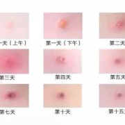 怀孕期间出水痘怎么办（怀孕期间出水痘怎么办呢）