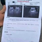 孕期附件疼（怀孕了右侧附件区囊肿怎么办）