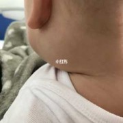 胎儿后颈部（宝宝切除扁桃体后耳朵下淋巴结肿大）