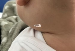 胎儿后颈部（宝宝切除扁桃体后耳朵下淋巴结肿大）