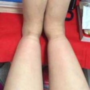 腿上有袜子勒出的印是什么回事,孕妇肚子勒印影响胎儿吗
