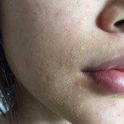 孕期脂溢性皮炎怎么办（孕期脂溢性皮炎怎么治）