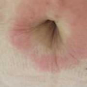 孕期肚脐眼痒（6个月孕妇肚子痒怎么办？可以用手抓吗）