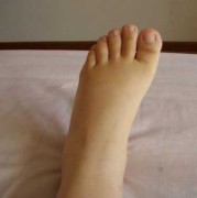 孕期腿手肿（孕期腿肿手肿）