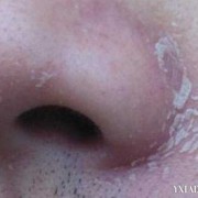 孕期鼻头痒（孕期鼻头痒是怎么回事）