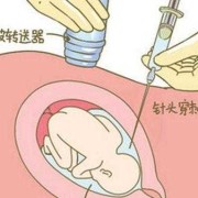 永存右脐静脉对胎儿有影响吗,右脐静脉的胎儿能要吗需要做羊水穿刺吗?