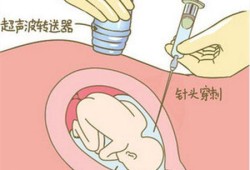 永存右脐静脉对胎儿有影响吗,右脐静脉的胎儿能要吗需要做羊水穿刺吗?