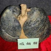 促进胎儿肺成熟的针多少钱（孕37周可以打胎儿肺部成熟的针吗）