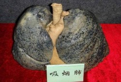 促进胎儿肺成熟的针多少钱（孕37周可以打胎儿肺部成熟的针吗）