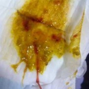 孕期血丝（孕妇便血怎么办，这是什么原因造成呢）