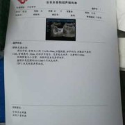 孕期胸积水（我怀孕了陶氏腔积液是怎么回事）