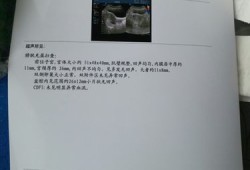孕期胸积水（我怀孕了陶氏腔积液是怎么回事）