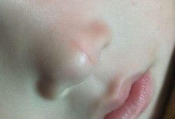 胎儿鼻前皮肤增厚（胎儿鼻前皮肤增厚畸形几率）