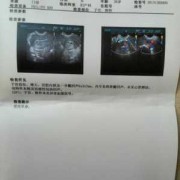 胎儿没有心管搏动（胎儿没有心管搏动）