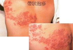 孕妇得带状疱疹对胎儿有什么影响,孕妇泡疹会影响胎儿吗