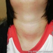 甲亢什么症状,孕期甲亢症状表现有哪些