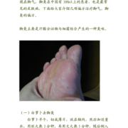 孕期脚气怎么办（孕期的脚气该怎样治疗）