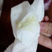 孕期霉菌是什么症状（孕妇白带检查霉菌为阳性有问题吗）