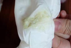 孕期霉菌是什么症状（孕妇白带检查霉菌为阳性有问题吗）