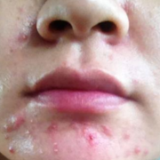 为什么有的人脸上没有痘和斑,孕期不长痘痘生完宝宝痘痘又冒出了