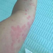 怀孕了得荨麻疹怎么办,孕妇有荨麻疹会不会影响胎儿