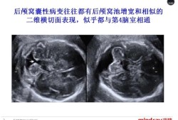 胎儿脑积液是怎么回事（胎儿颅后窝池增宽怎么回事）