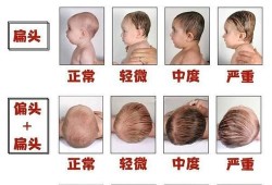 胎儿头太低怎么办（胎儿头太低是怎么回事）