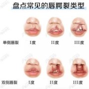 兔唇是因为孕期生气吗（怀孕兔唇几率大吗）