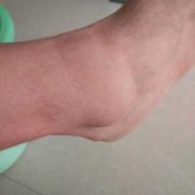 脚扭了,没肿,怎么办,孕期不肿正常的吗