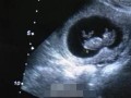 怀孕八个月了B超显示宝宝手脚偏短咋办,孕晚期胎儿头大腿短是什么原因