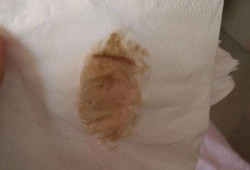怀孕后内分泌物发黄是不是正常,孕期分泌物发黄怎么办不痛不痒