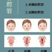 胎儿唇裂（胎儿唇裂是什么原因造成的）