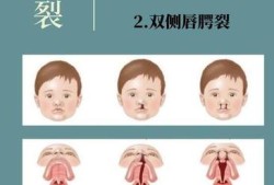 胎儿唇裂（胎儿唇裂是什么原因造成的）