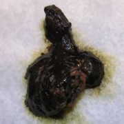孕妇大便吃益中是黑色的怎么回事,孕期大便黑色是什么原因