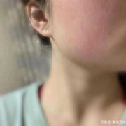 孕期脸上过敏怎么办,孕期过敏图片大全