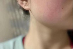 孕期脸上过敏怎么办,孕期过敏图片大全