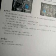 胎儿25周四维彩超显示三尖瓣少量反流，其它正常,25周胎儿四维彩超图