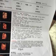胎儿心脏彩超有强光点（胎儿右心室有强光点）