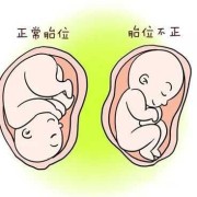 胎位不正是胎儿畸形吗（胎位不正是胎儿畸形吗）