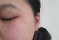 怀孕后期脸上长斑是怎么回事了,孕期长斑图片大全