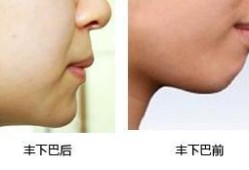 胎儿下巴短（下巴短怎么让下巴变长）