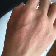 孕期皮肤干痒（怀孕后皮肤发痒是怎么回事）